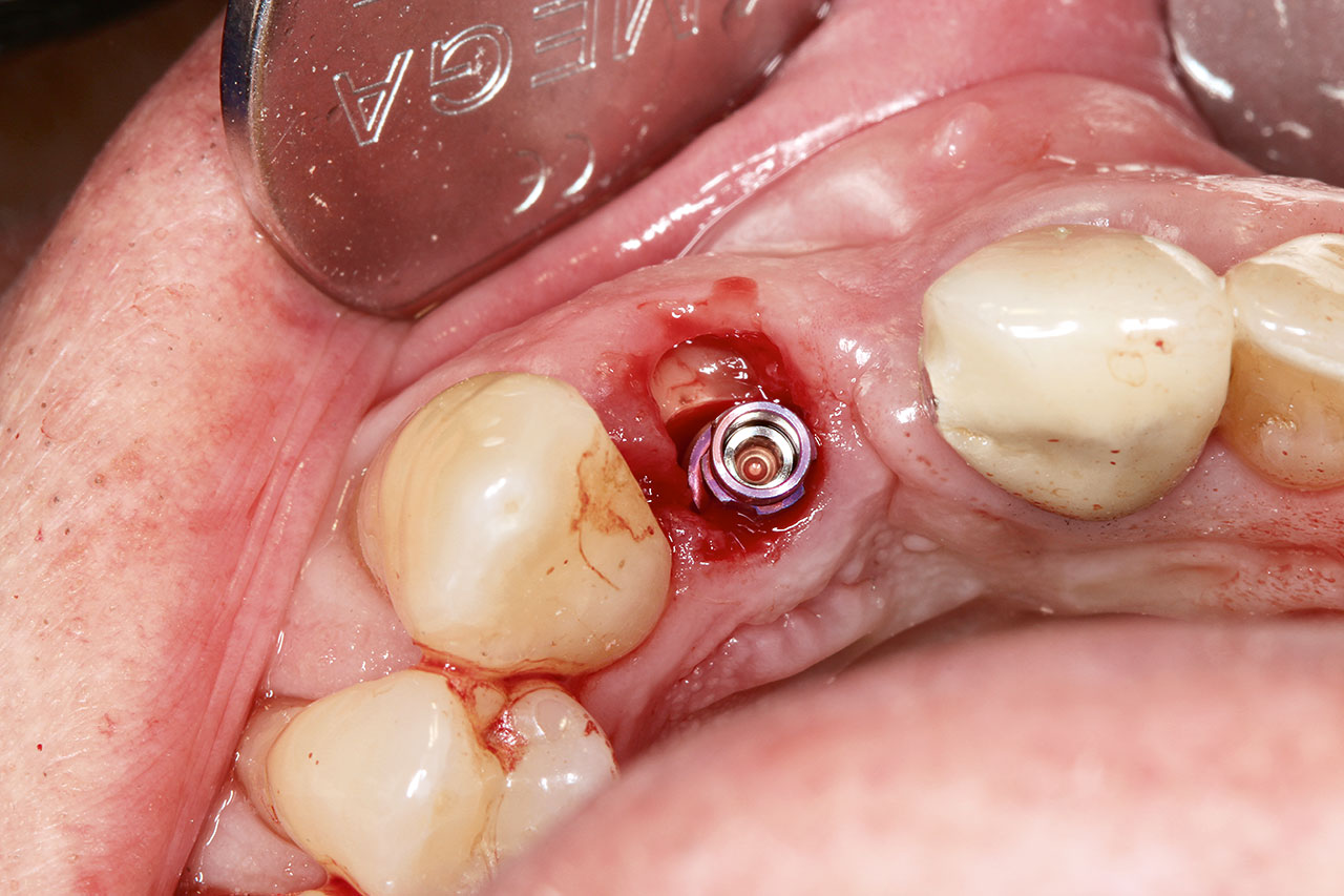 Abb. 4 Implantat in situ.