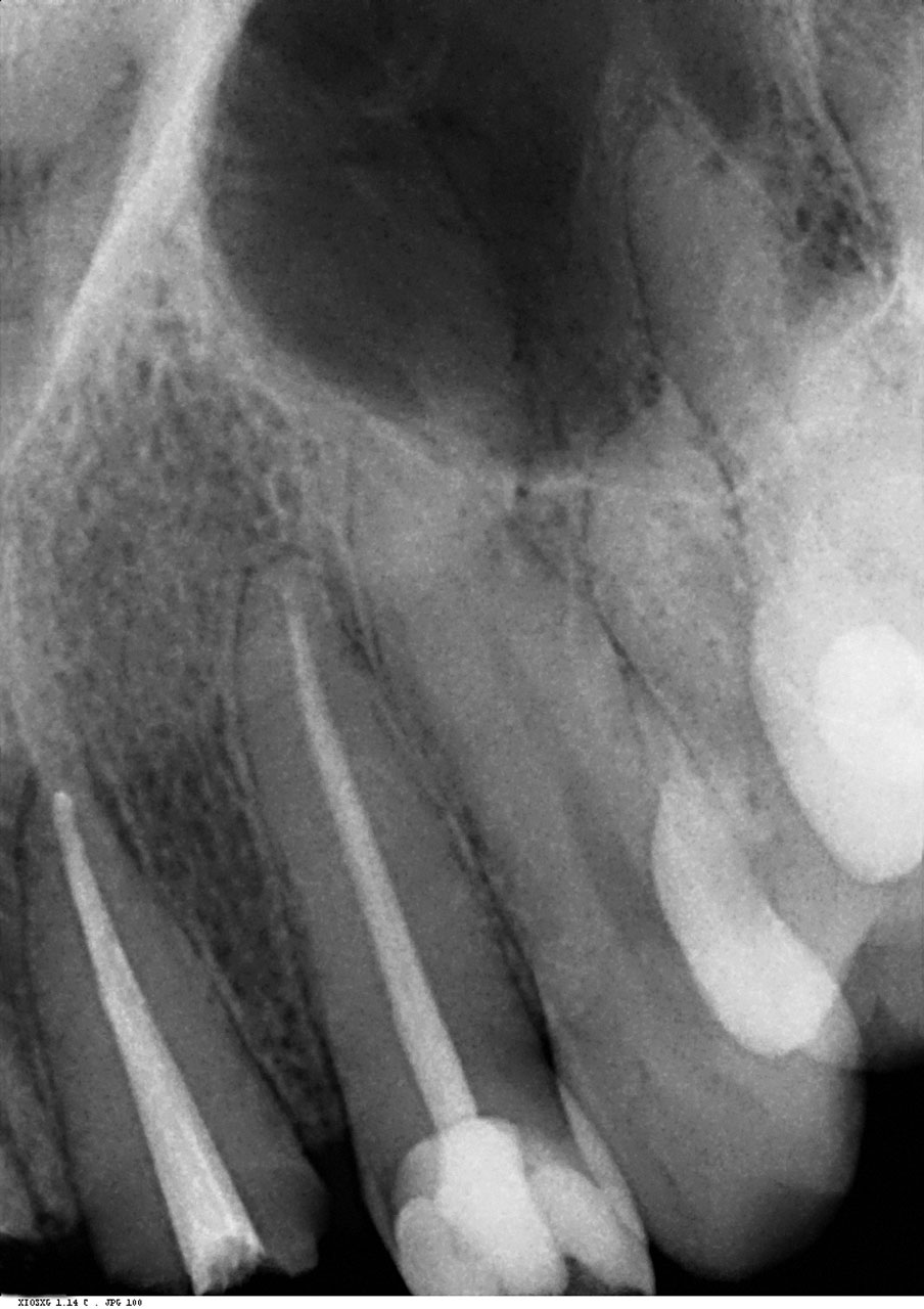 Abb. 11 Röntgenbefund des Zahns 21 nach Entfernung von Krone und Aufbau.