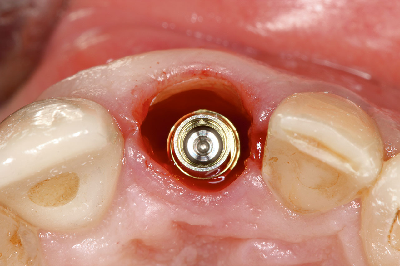 Abb. 13 Implantat in situ.