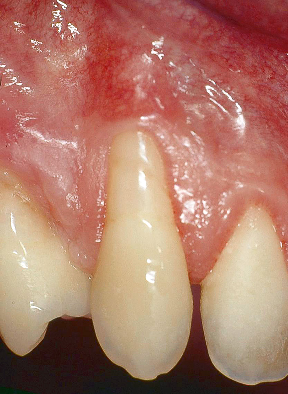 Abb. 15 Wurzeldeckung eines oberen Eckzahns (zehn Jahre Beobachtungszeitraum): parodontale Rezession an Zahn 13 präoperativ.