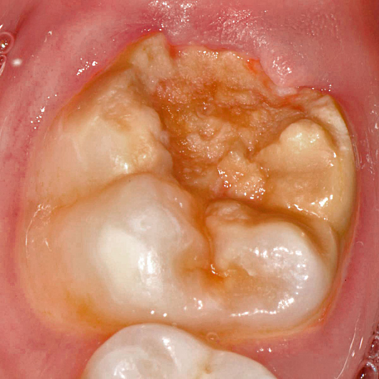 Abb. 4 Hypomineralisation mit einem großflächigen, präeruptiven Schmelz­einbruch an einem ersten bleibenden Molaren. Aufgrund des Umfangs der Strukturstörung sind bereits Anteile des Dentins exponiert.