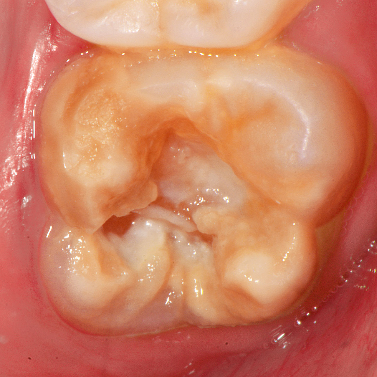 Abb. 9 An einem MIH-Molaren mit einem mehrflächigen Schmelzeinbruch und Dentinexposition ...