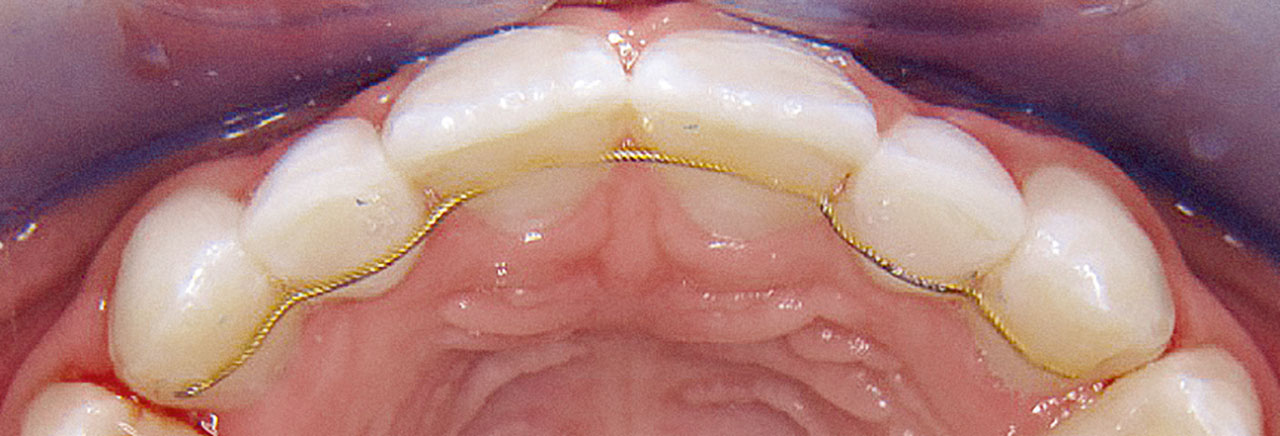 Abb. 2 Stabilisierung des kieferorthopädischen Behandlungsergebnisses sowie der Zähne 52 und 62.