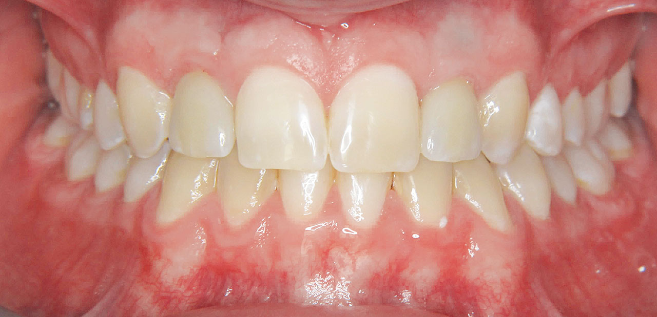 Abb. 4 Therapie: Lückenöffnung und Insertion von Dentalimplantaten Regio 12 und 22.
