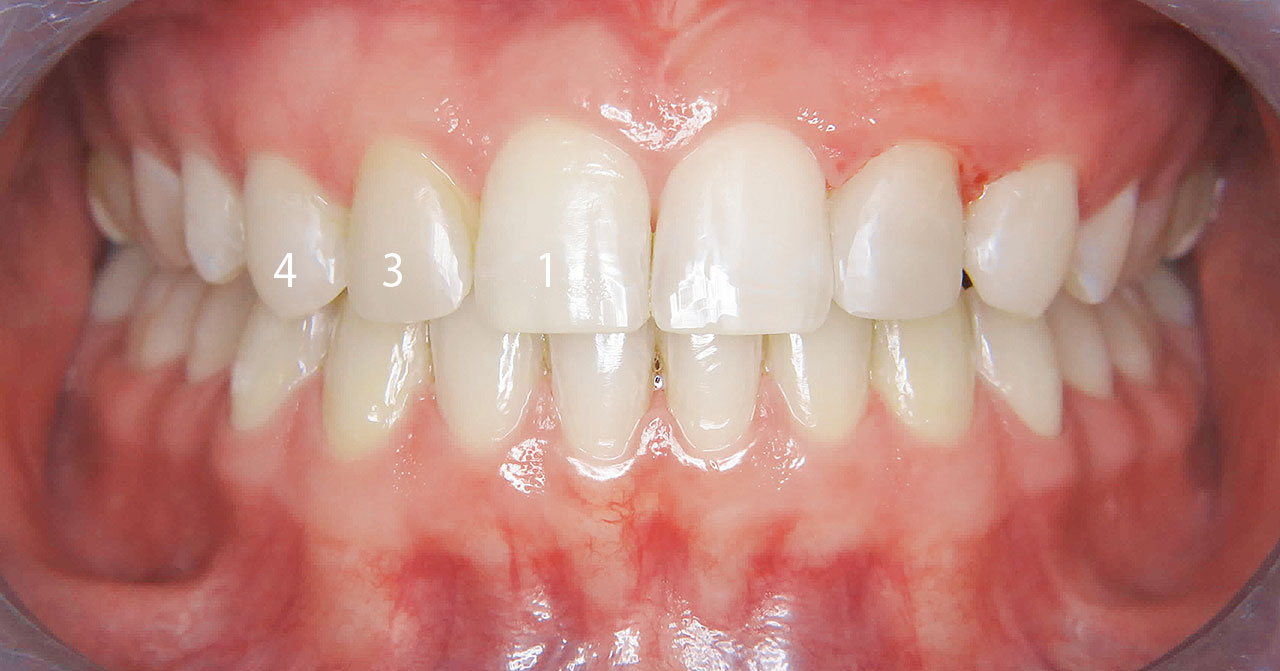 Abb. 7 ... und kosmetische Zahnumformung der mesialisierten Zähne.