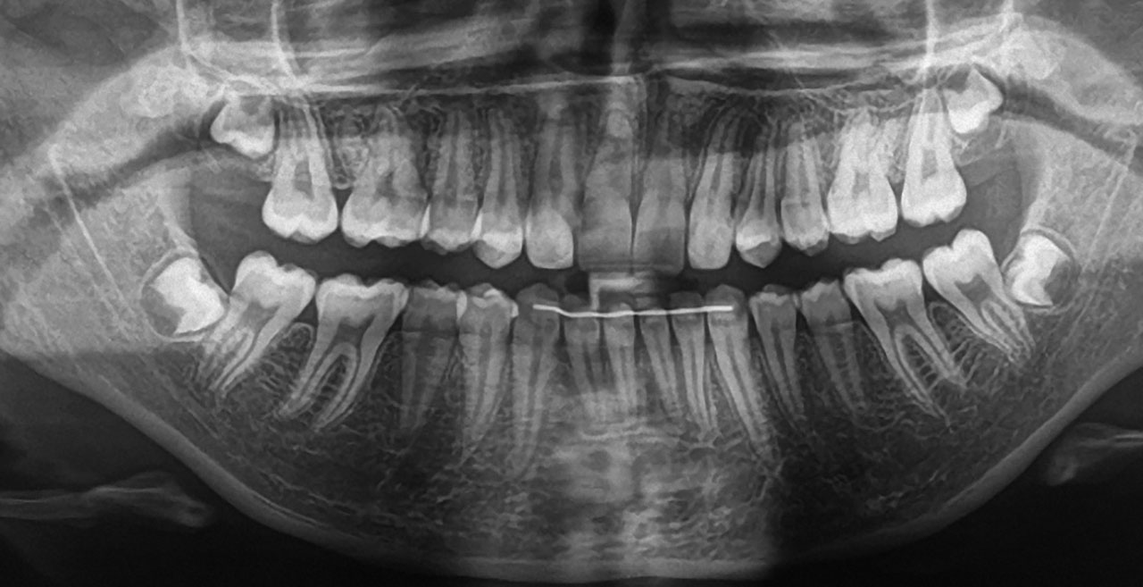 Abb. 9 Röntgenkontrolle nach vollzogenem Lückenschluss zur Überprüfung von Wurzelresorptionen und/oder Zahnangulationen.