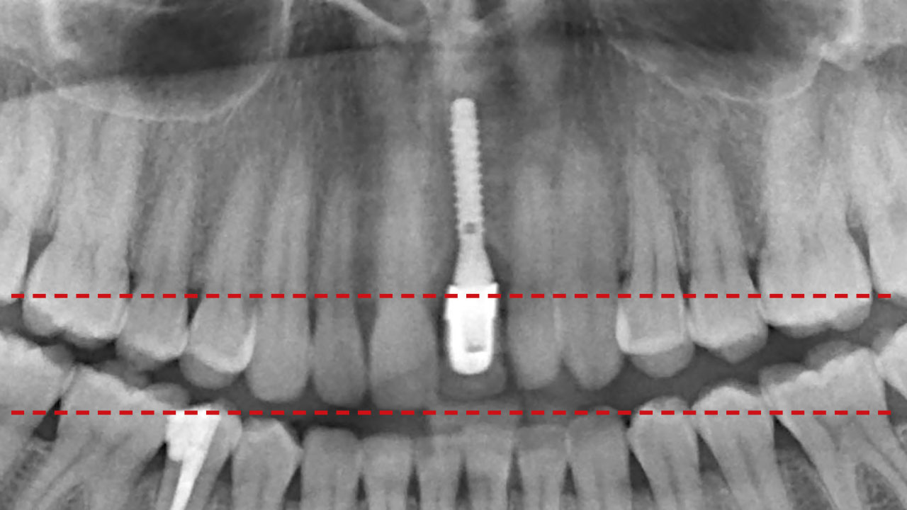 Abb. 10 Vertikale Veränderung der Nachbarzahn-Implantat-Relation im Erwachsenenalter: Nach Implantatinsertion sind die natürlichen Zähne im Verlauf von 8 Jahren in Relation zum Implantat um ca. 2 mm eruptiert.