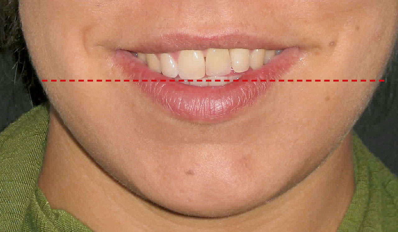 Abb. 11 Das Implantat wirkt in Relation zur Lippe infrapositioniert.
