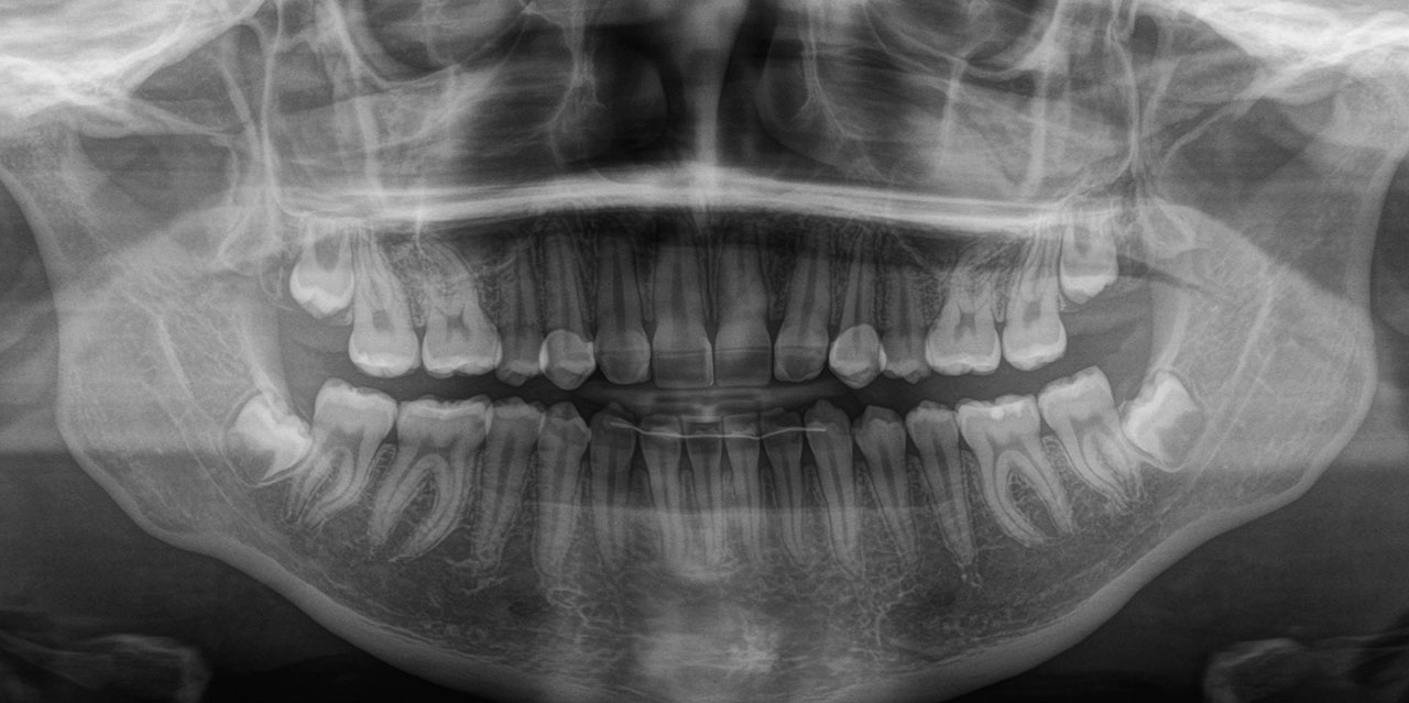 Abb. 18 Röntgenkontrolle nach vollzogenem Lückenschluss zur Überprüfung von Wurzelresorptionen und Zahnangulationen.