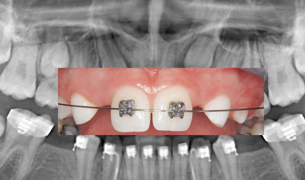 Abb. 22 
kieferorthopädischer Lückenschluss bei Nichtanlagen oberer seitlicher Schneidezähne ohne skelettale Verankerung. Aplasie der Zähne 12 und 22, wobei die Eckzähne, bedingt durch einen natürlichen Mesial-Drift, an Position 12 und 22 durchbrechen.