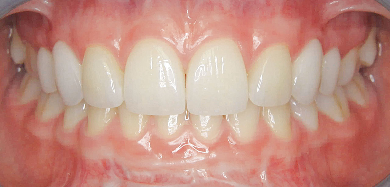 Abb. 25 Endsituation nach Umformung der Zahnnummern 1, 3, 4 und 5 mittels Keramikveneers.