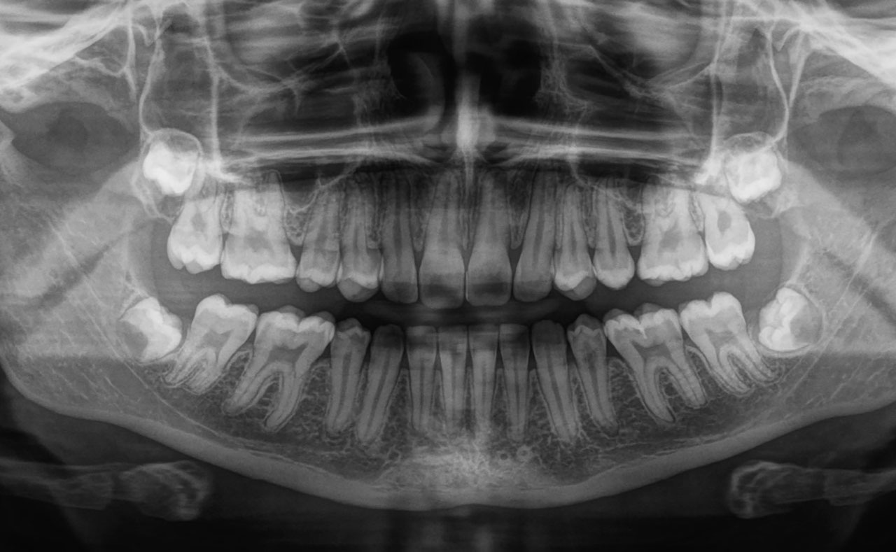 Abb. 29 Röntgenkontrolle nach vollzogenem Lückenschluss zur Überprüfung von Wurzelresorptionen und Zahnangulationen.