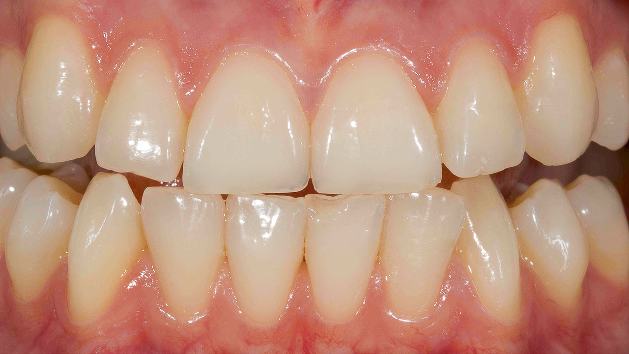 Abb. 1a Situation vor der professionellen Zahnaufhellung bei einer 22-jährigen Patientin.