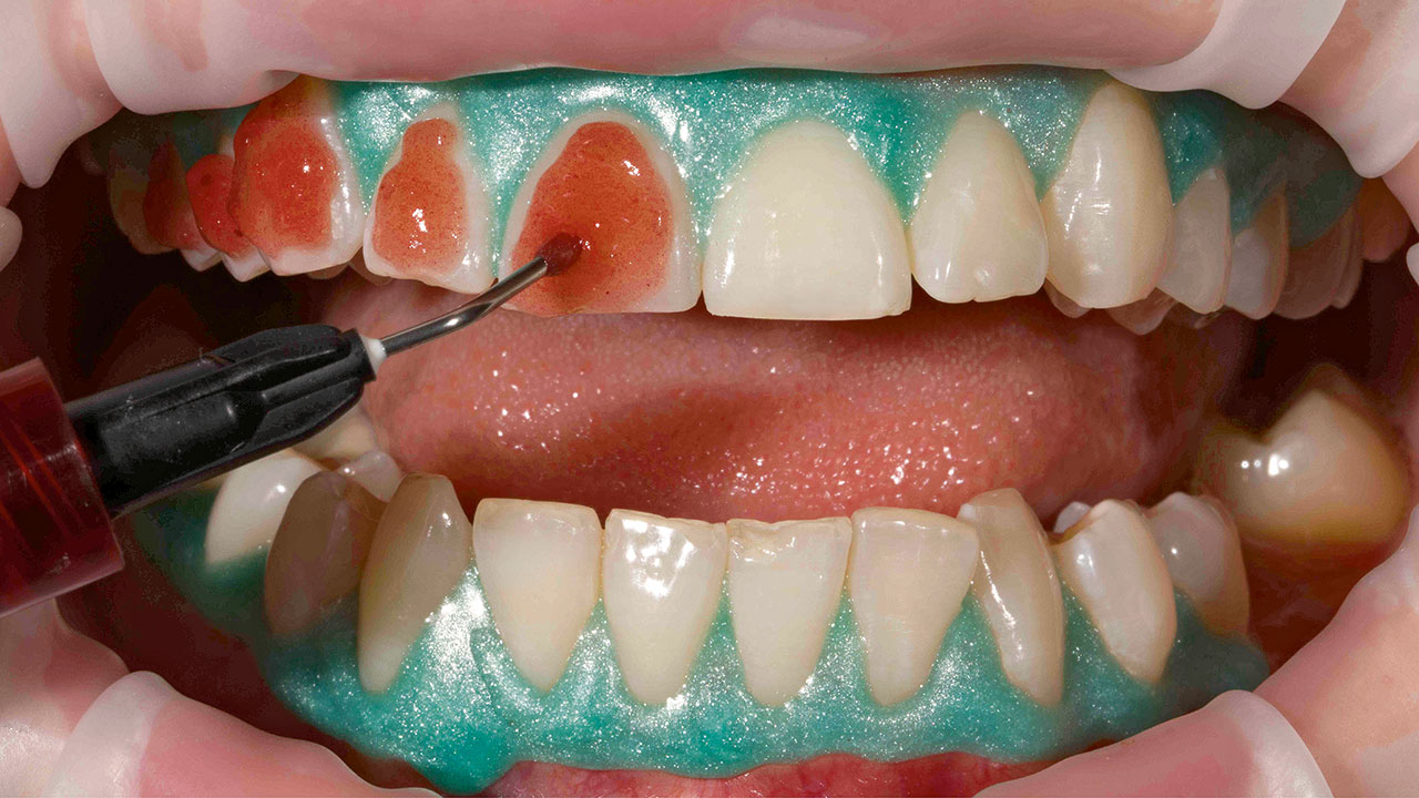 Abb. 5 Nach Schutz der Weichgewebe wird das Bleichmittel (Opalescence®) direkt auf die aufzuhellenden Zähne appliziert.