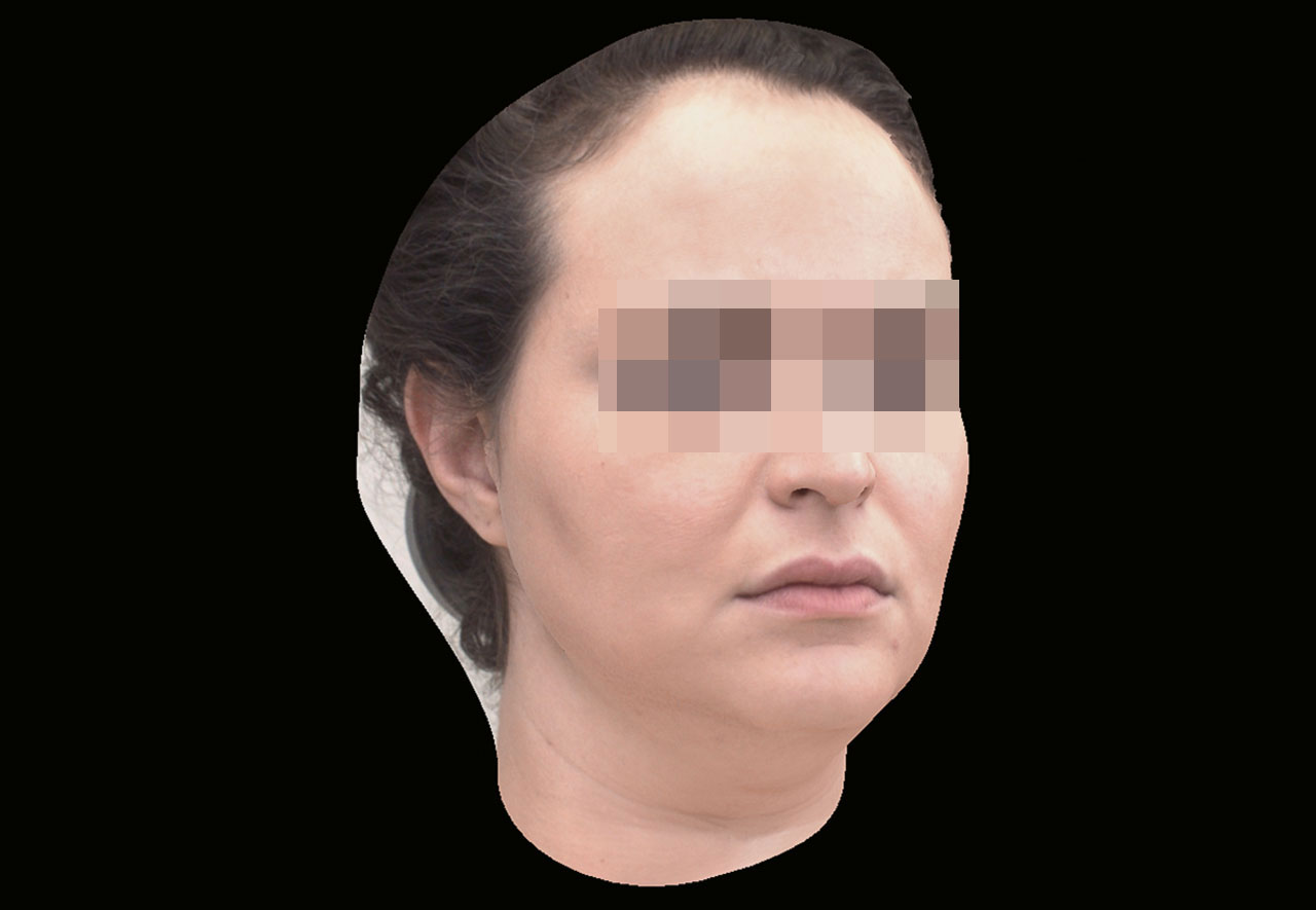 Abb. 9 3-D-Digitalisierung des Patientenkopfs.