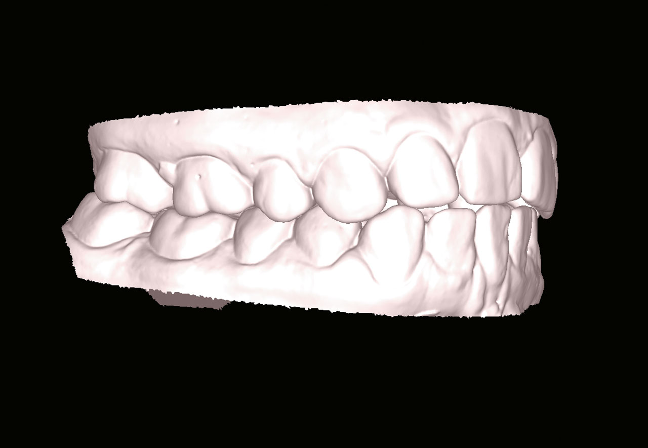 Abb. 10 Modelle der oberen und unteren Zahnreihe in Schlussbissstellung.