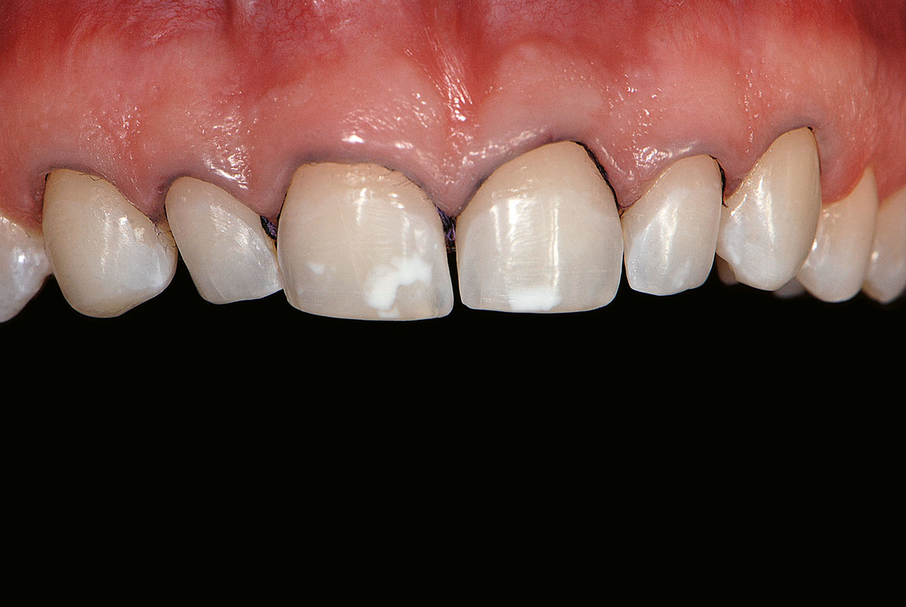 Abb. 6 Die fertig präparierten Zähne vor der Abformung.