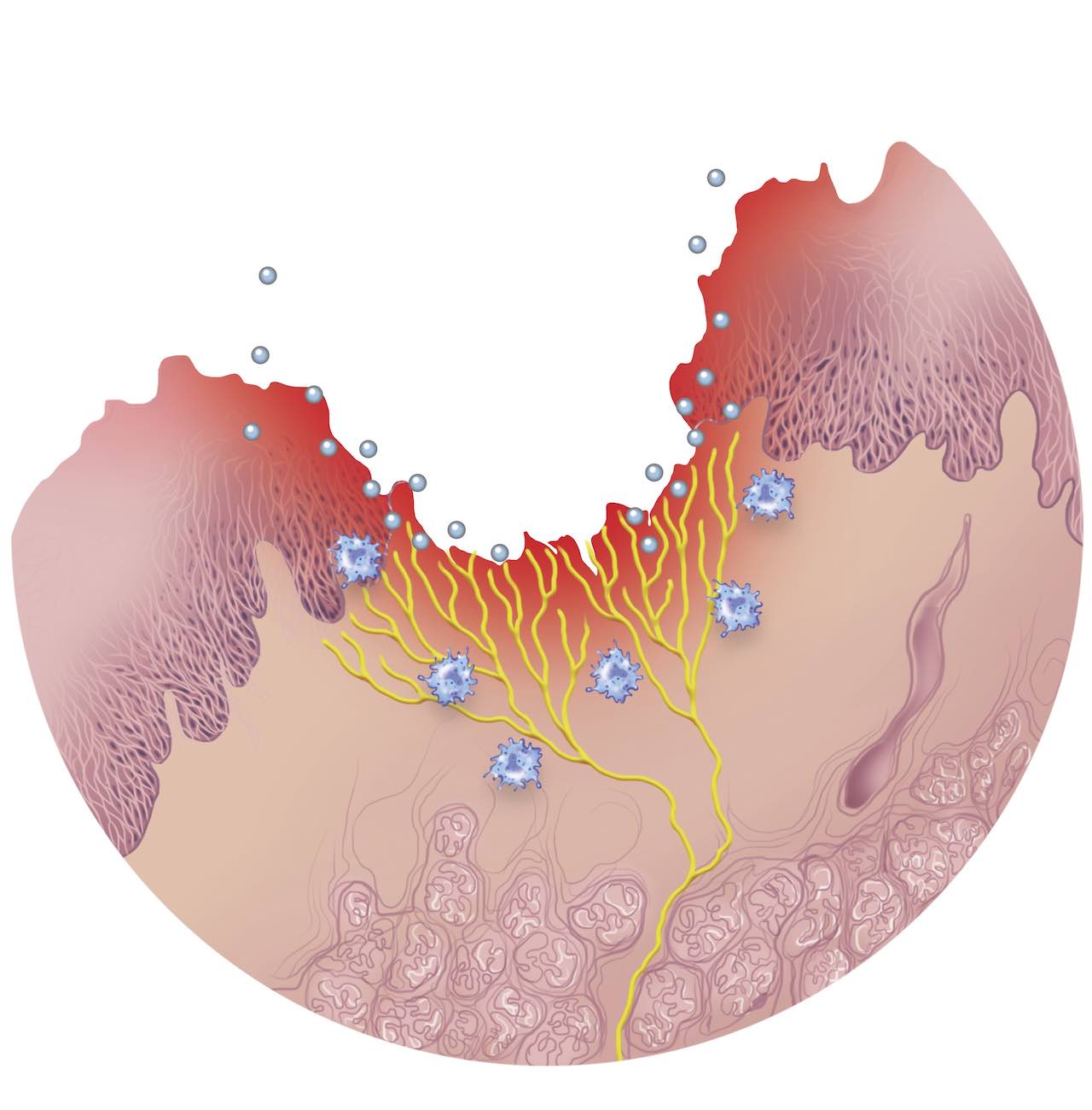 Schema geschädigter Schleimhaut mit intensiver Entzündungsreaktion, einwandernden Neutrophilen und Lymphozyten.