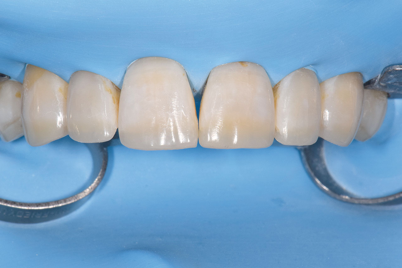 Abb. 32 ... und ein direktes Komposit anmodelliert, um den Übergang zwischen Zahn und Restauration zu kaschieren und der Schneidekante mehr Transparenz und Transluzenz zu verleihen.