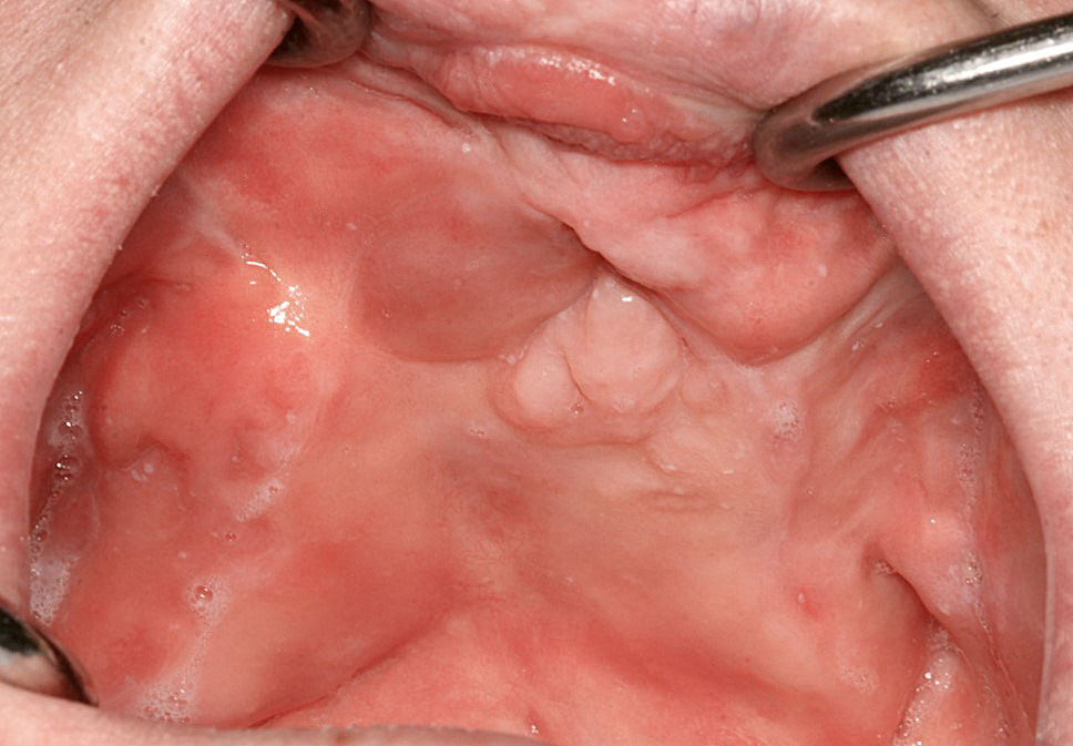 Abb. 1 Zahnlose Oberkiefersituation mit narbiger Zerklüftung im anterioren Bereich. Das Vestibulum ist abgeflacht.