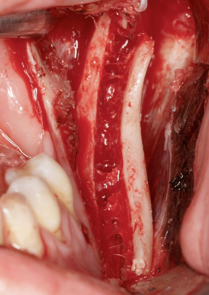 Abb. 5 Als Knochentransplantat wird ein kortikaler Span aus dem linken Kieferwinkel entnommen.