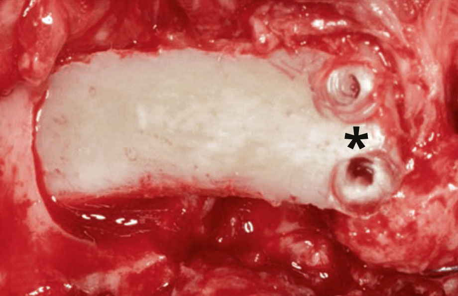 Abb. 9 Die Fixierung des Transplantats erfolgt mit resorbierbaren Pins.