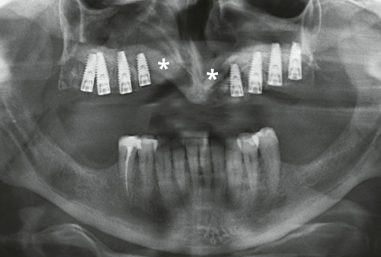 Abb. 11 Das postoperative Röntgenbild zeigt die Kieferspaltosteoplastik (*) zur Rekonstruktion des anterioren Oberkiefers und die simultan inserierten Implantate.