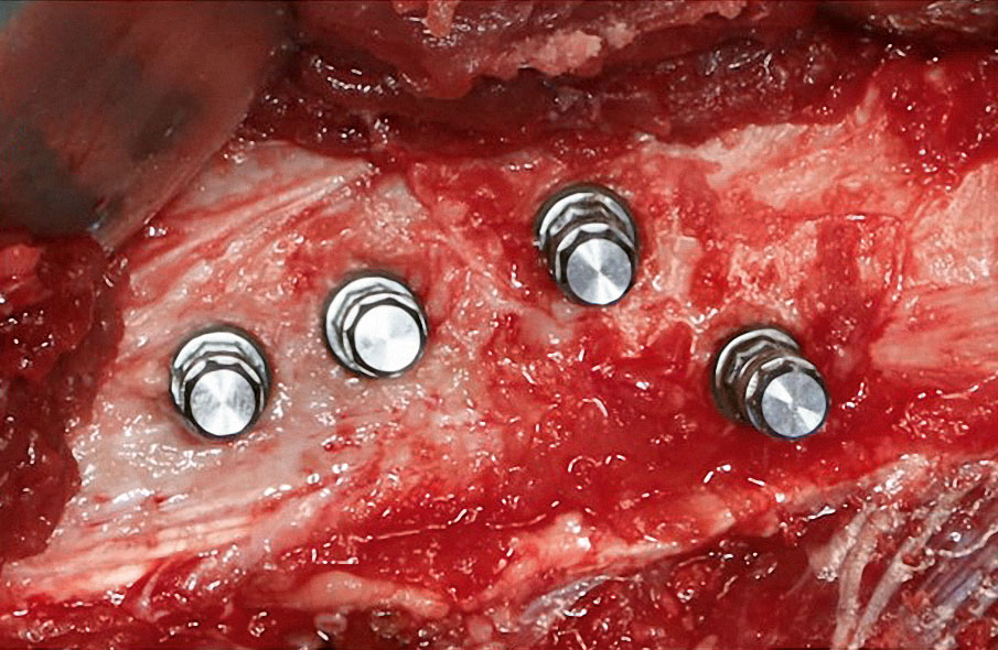 Abb. 13 Das Fibulatransplantat wird am Unterschenkel präfabriziert und die Implantate werden inseriert.