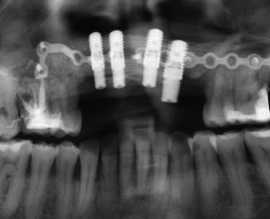 Abb. 16 Das postoperative Röntgenbild zeigt die knöcherne Konsolidierung 6 Monate nach dem rekonstruktiven Eingriff.