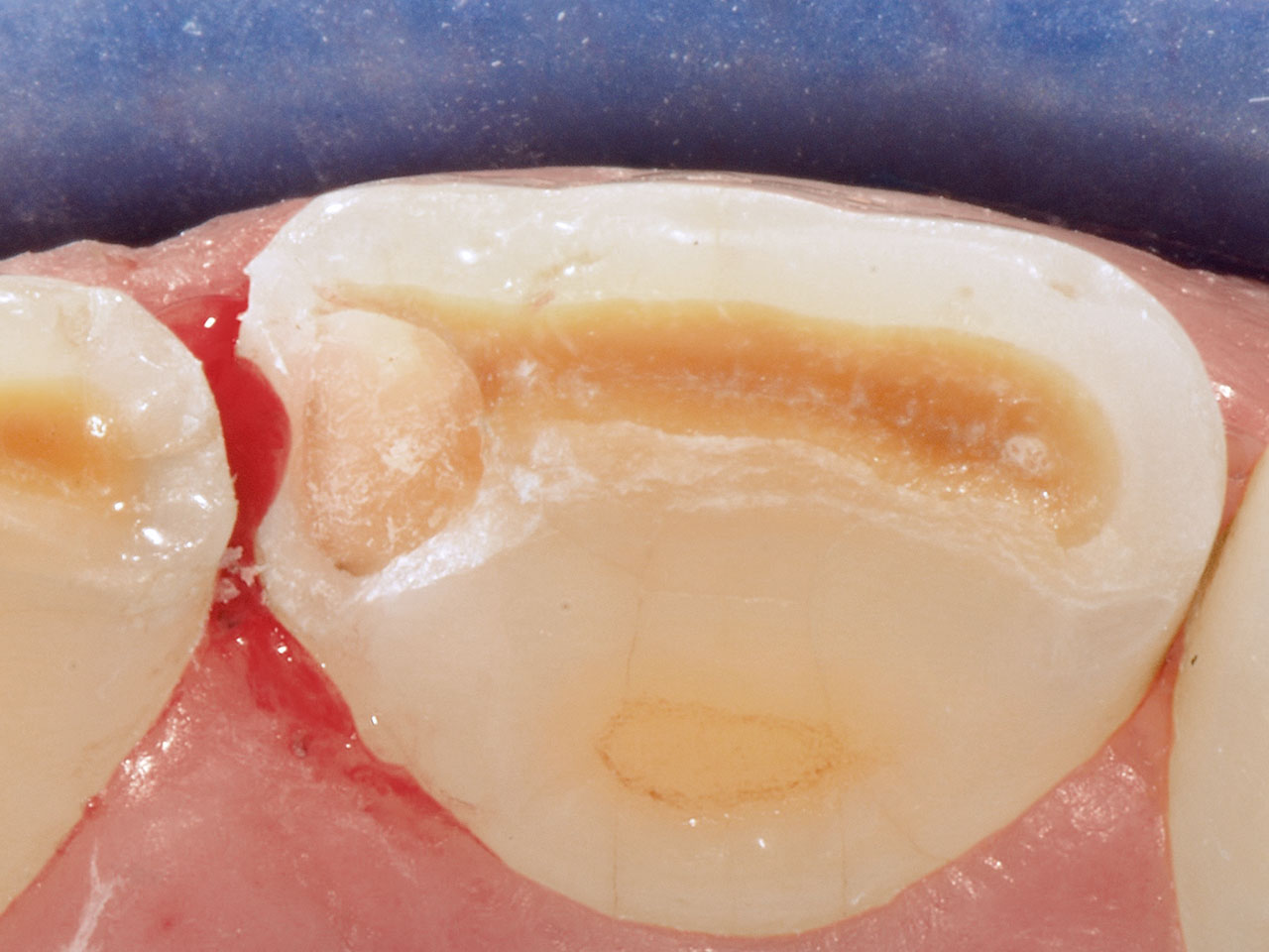 Abb. 1 Kontamination des Zahns 21 mesial mit Blut, welche vor Beginn des Ätzschrittes im Rahmen der adhäsiven Vorbehandlung (OptiBond FL, Kerr, Biberach) erfolgte.