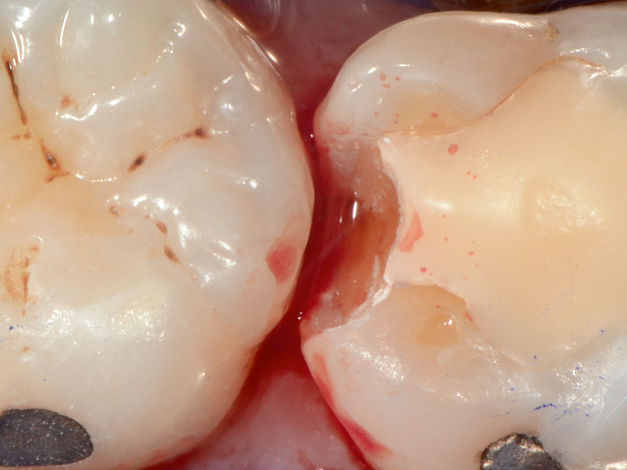 Abb. 4 Reparaturfüllung einer Klasse-II-Kavität an Zahn 37 mesial mit epigingivalem Rand. Nach der Kontamination mit Blut ...