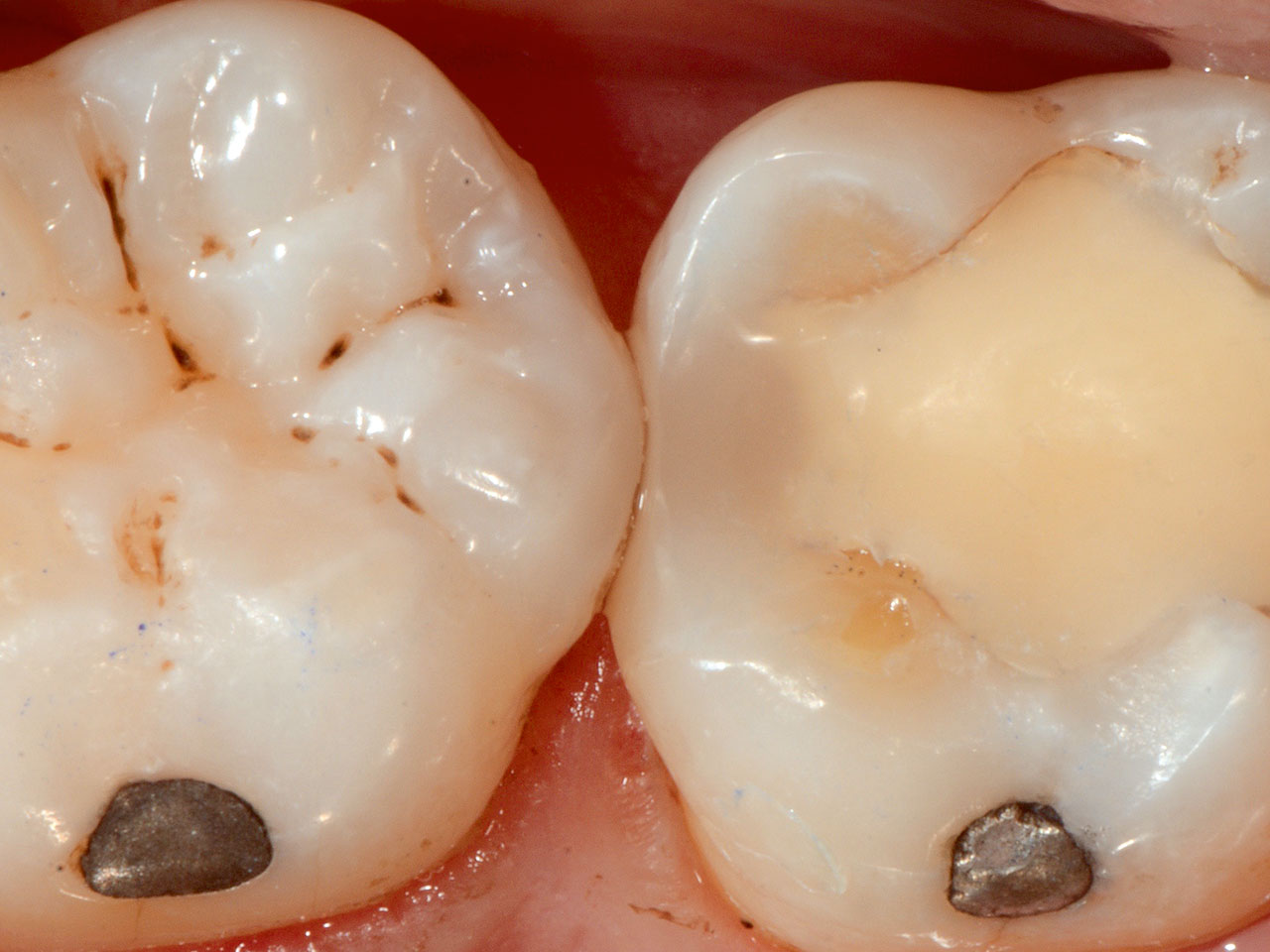 Abb. 9 Die Restauration des Zahns erfolgte mittels Komposit (Ceram.X Universal, Dentsply Sirona).