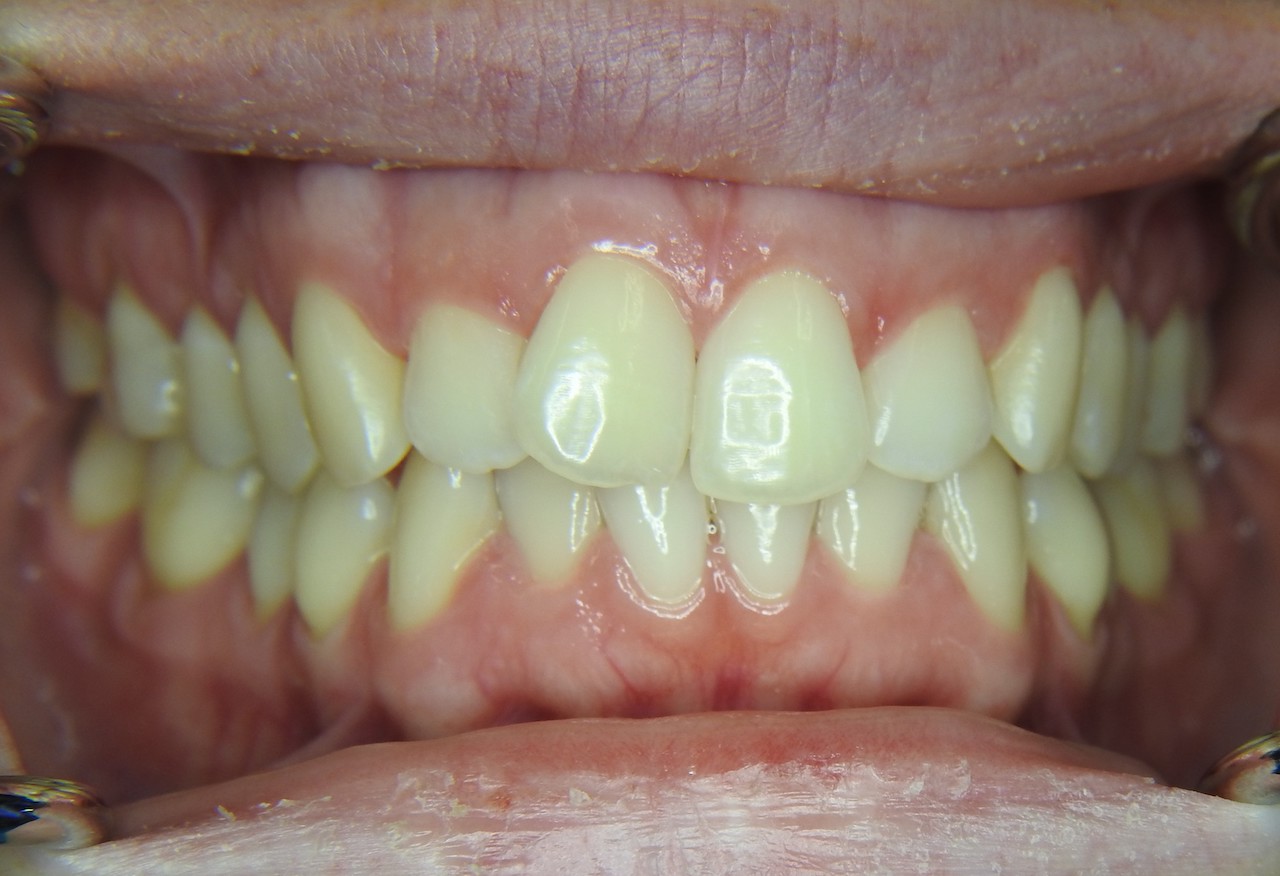 Abb. 1: Klinische Ausgangssituation, Frontalansicht. Ein wesentliches Ziel der Aligner-Therapie ist es, die Zähne 11 und 21 zu derotieren, da die Patientin die Schmetterlingsstellung stört. (Foto: Praxis Dr. Rebecca Komischke, Medebach)
