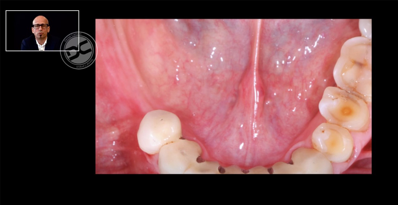 Mit klinischen Fotos und Videos zeigen die Experten eine Vielzahl von Behandlungsfällen. (Screenshot: DC Curriculum Implantology)