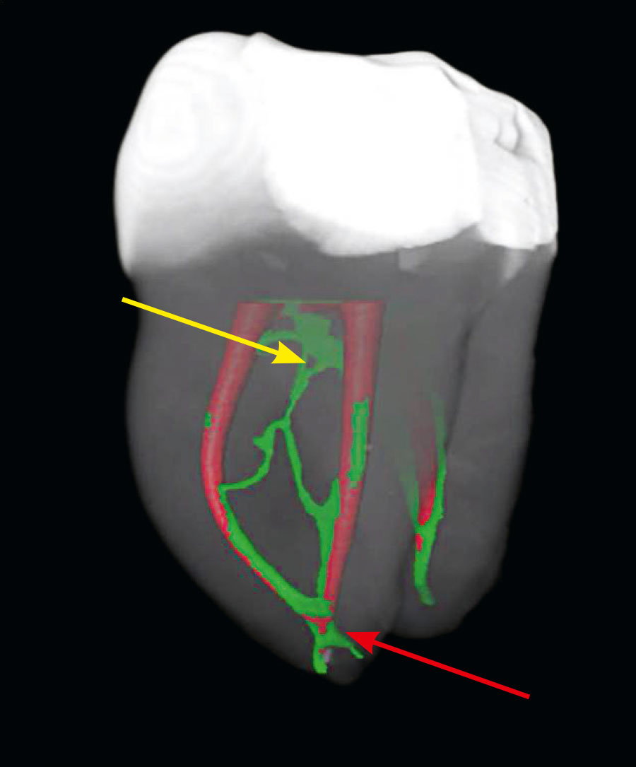 Abb. 2 Mikro-CT-Aufnahme eines Unterkiefermolaren in der Ansicht von mesiolingual. Die Isthmen (gelber Pfeil) und apikalen Ramifikationen (roter Pfeil) konnten durch die mechanische Instrumentation (rot eingefärbte Areale) nicht erreicht werden.