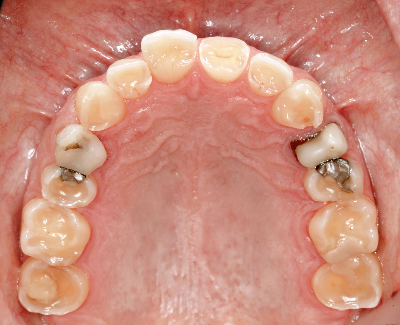 Abb. 1 Bei der Erstvorstellung des Patienten zeigten sich massive Verschleißerscheinungen der Zahnhartsubstanz in Ober- und Unterkiefer. Ansicht Oberkiefer von okklusal.