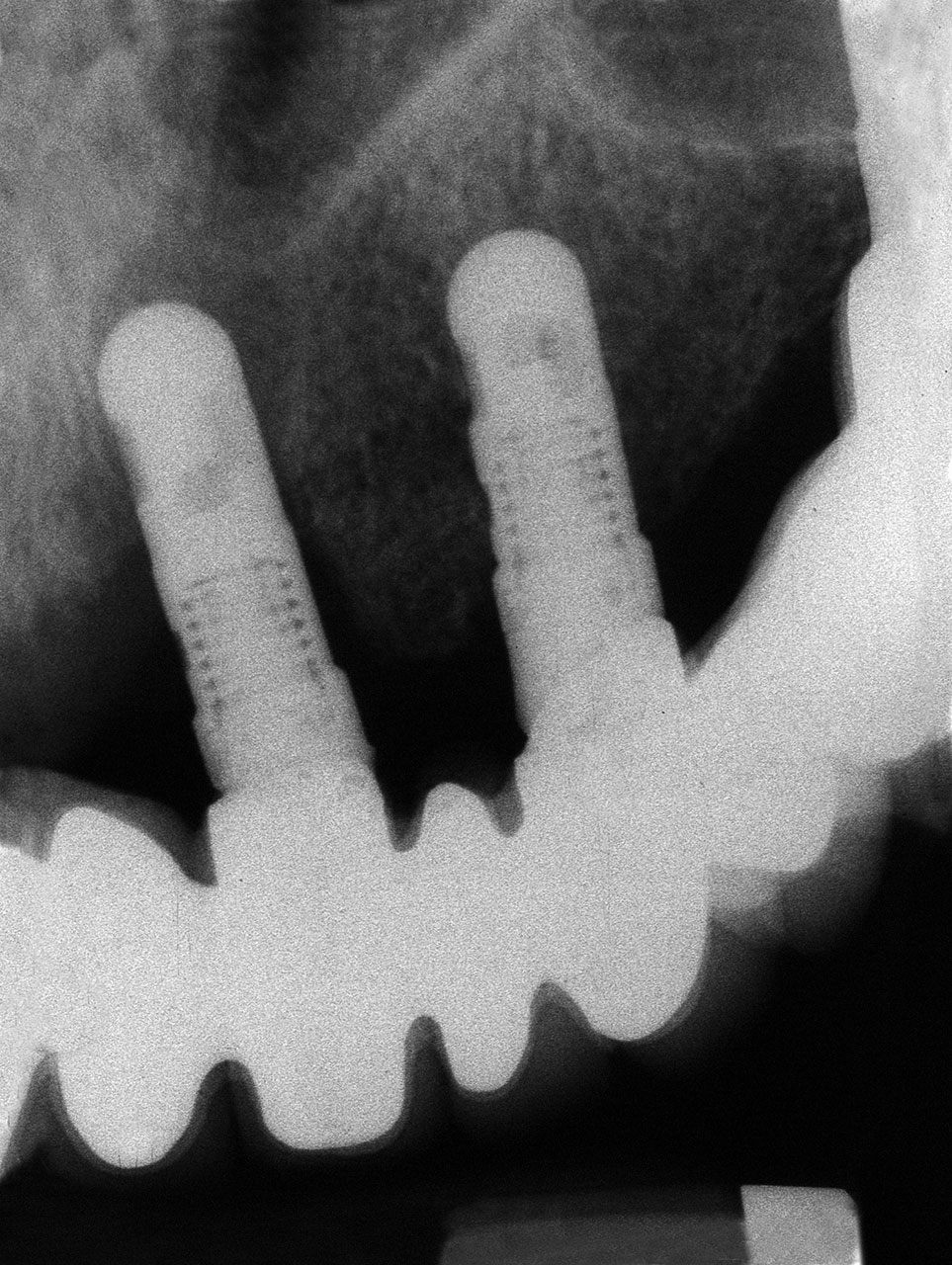 b) massiver radiologischer Knochenverlust sowie Hinweis auf Passungsprobleme der Prothetik im Zahnfilm