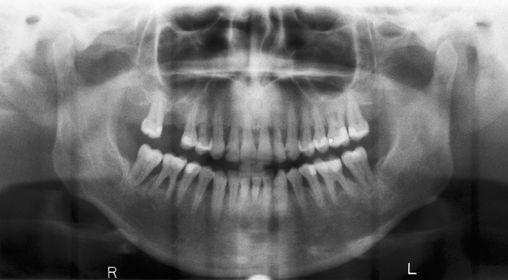 Abb. 6 ... erst bei der Erhebung des Parodontalstatus und der Befundung des Röntgenbilds wird das Ausmaß des klinischen Attachmentverlusts deutlich.