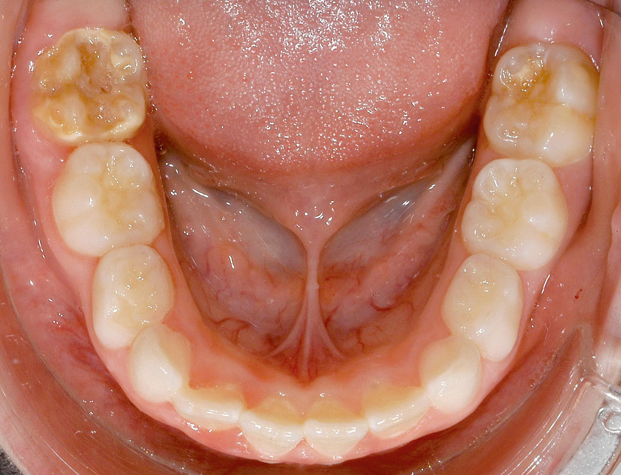 Abb. 6  Molaren- Inzisiven-Hypomineralisation mit unsymmetrischer Ausbildung; Zahn 36 mit Schweregrad 1 und Zahn 46 mit Schweregrad 2 nach Wetzel und Reckel<sup>24,17</sup>.