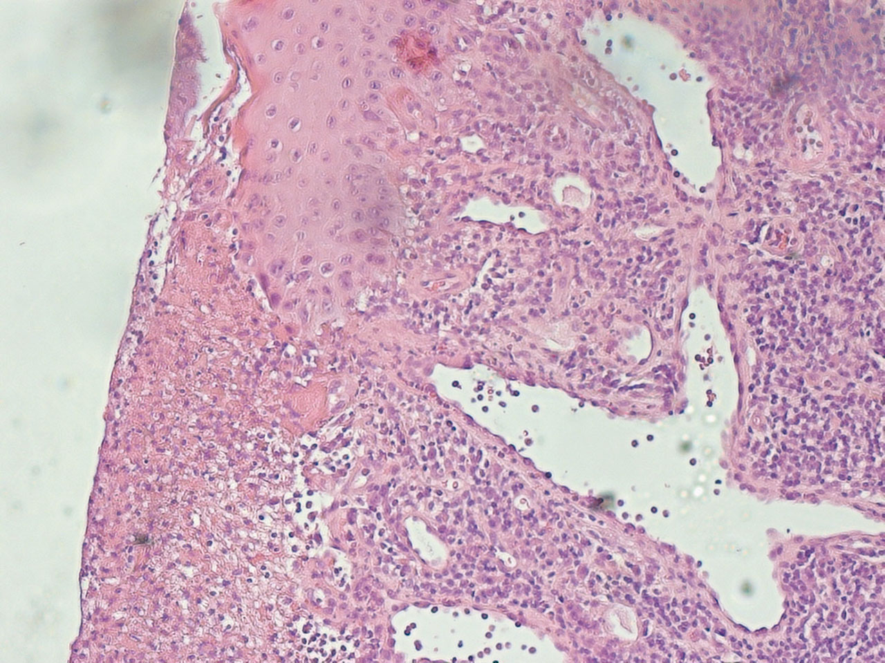 Abb. 8 Histologisches Bild einer aktinischen Keratose (Hämatoxylin-Eosin-Färbung, 10-fache Vergrößerung). Charakteristisch ist die hier zu sehende akanthotische Verbreiterung der Epidermis durch ein fingerförmiges Proliferat atypischer Keratinozyten.
