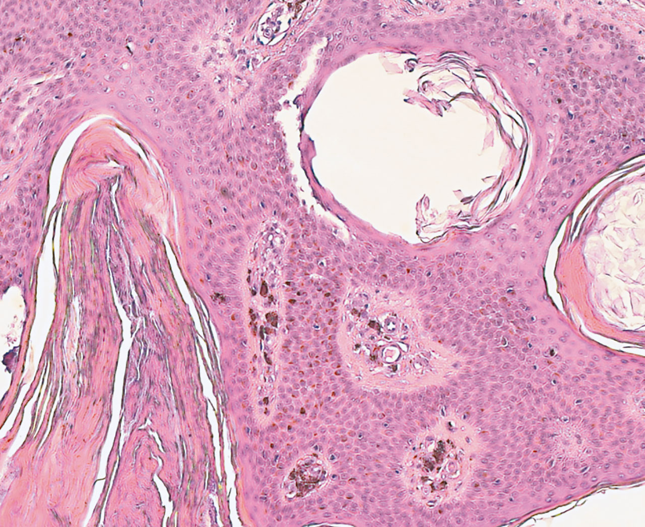 Abb. 15 Histologie einer seborrhoischen Keratose  (Hämatoxylin-Eosin-Färbung, 10-fache Vergrößerung). Neben adenoiden Proliferationen und multiplen hyperkeratotischen Hornperlen ist eine deutliche melanozytäre Hyperpimentierung zu erkennen.