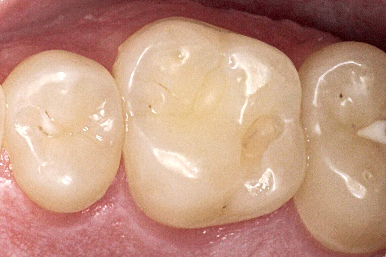 Ausgangssituation: Klasse-I-Füllung an Zahn 26 (Foto: Dr. med. dent. J. Schweppe)