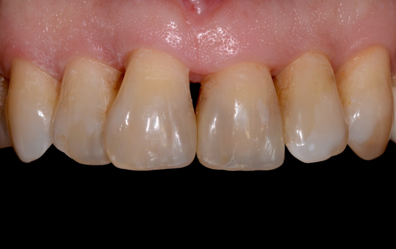 Die Situation nach Restauration der Zähne 12, 11, 21, 22 und 23