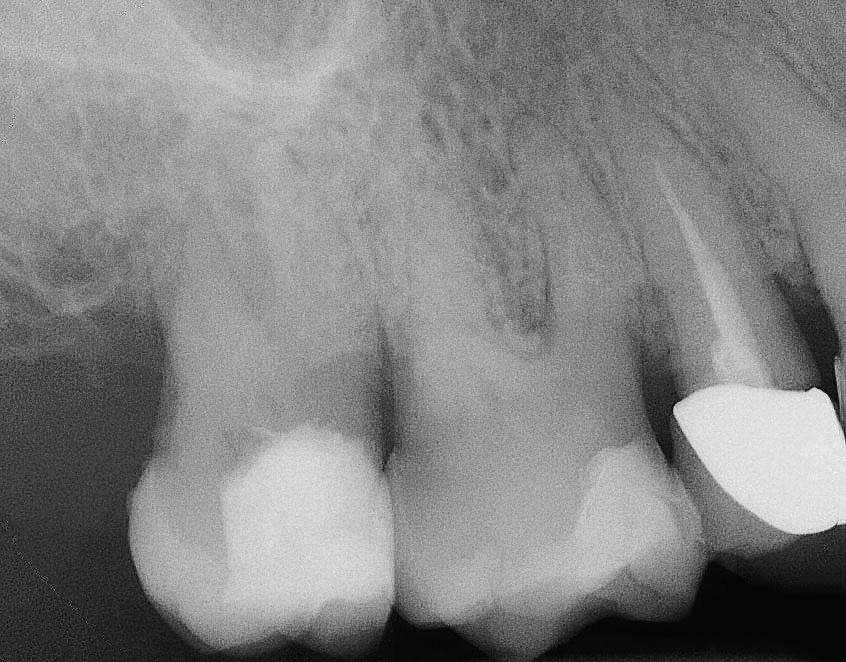 Abb. 1 An den Zähnen 16 und 17 sind kaum noch Wurzelkanäle zu erkennen. Das Volumen der Kronenpulpa an Zahn 16 ist stark reduziert. 