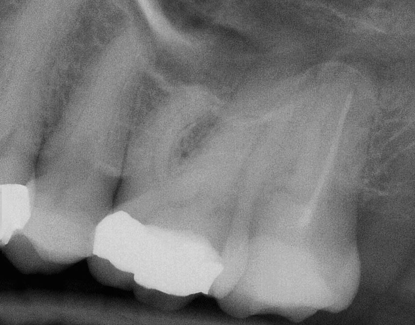 Abb. 2 Zahn 27 weist eine Wurzelfüllung im palatinalen Kanal auf. In der distalen und mesialen Wurzel sind keine Wurzelkanäle zu erkennen.