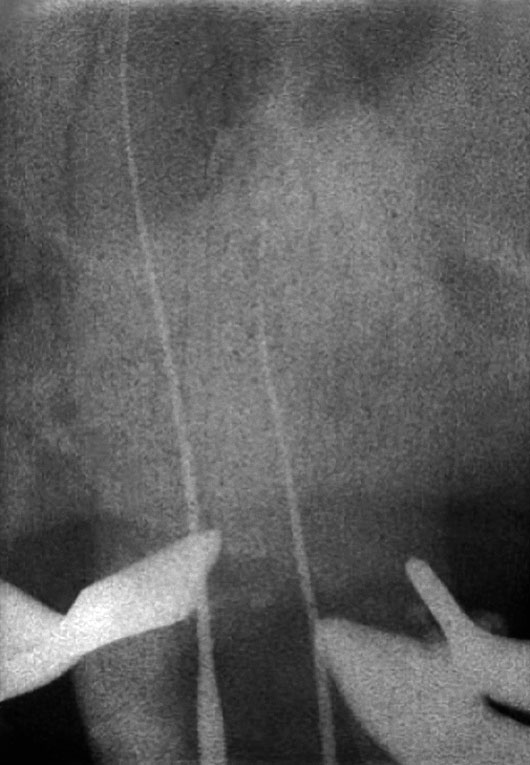 Abb. 3a Zwei Wurzelkanäle konnten erschlossen werden, die beiden übrigen, röntgenologisch nicht zu erkennenden Kanäle nicht.