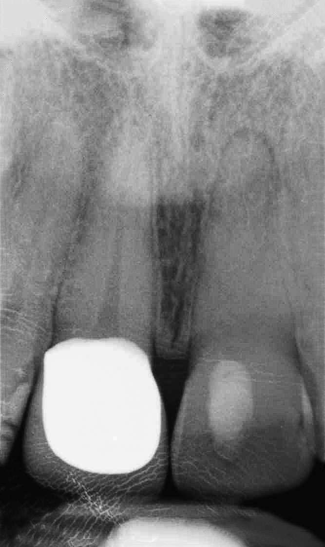 Abb. 5 An Zahn 21 ist radiologisch kein Wurzelkanal zu erkennen. Die periapikale Transluzenz deutet auf eine unvollständige Kalzifikation hin.