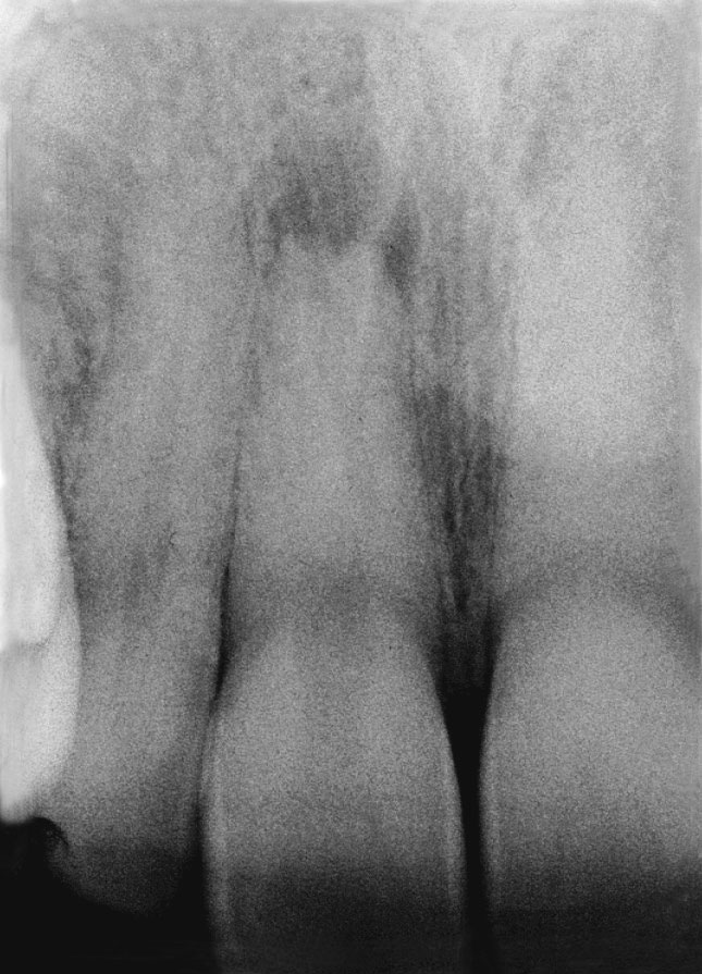 Abb. 6a Präoperative Aufnahme eines Frontzahnes mit Parodontitis apicalis und röntgenologisch vollständig kalzifiziertem Wurzelkanal nach früherem Trauma.