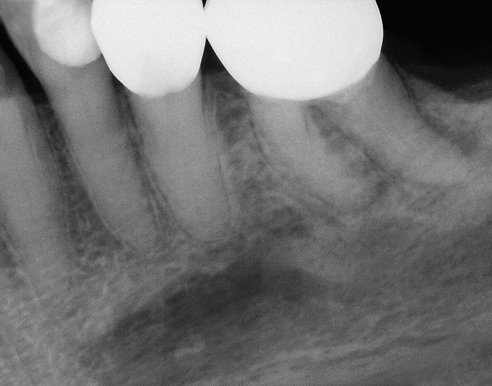 Abb. 7a An Zahn 36 ist kein Wurzelkanal zu erkennen. Der Zahn zeigt eine apikale Transluzenz.