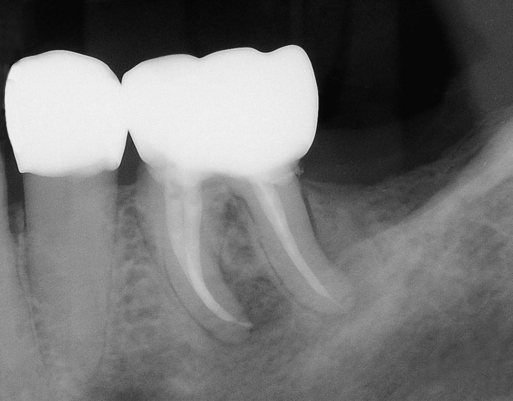 Abb. 7b Zahn 36 nach abgeschlossener Wurzelkanalbehandlung.